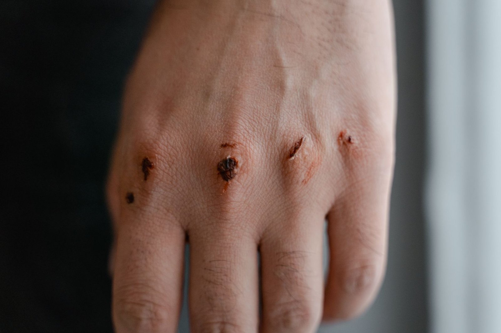 maggot wound therapy